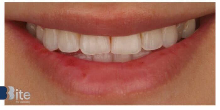 Smile whitening at Bite for Dentistry — After