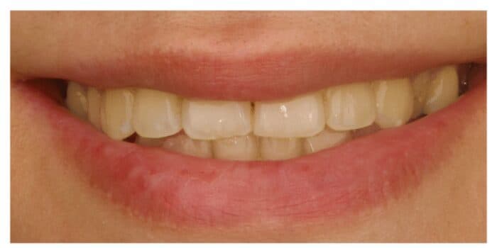 Smile whitening at Bite for Dentistry — Before