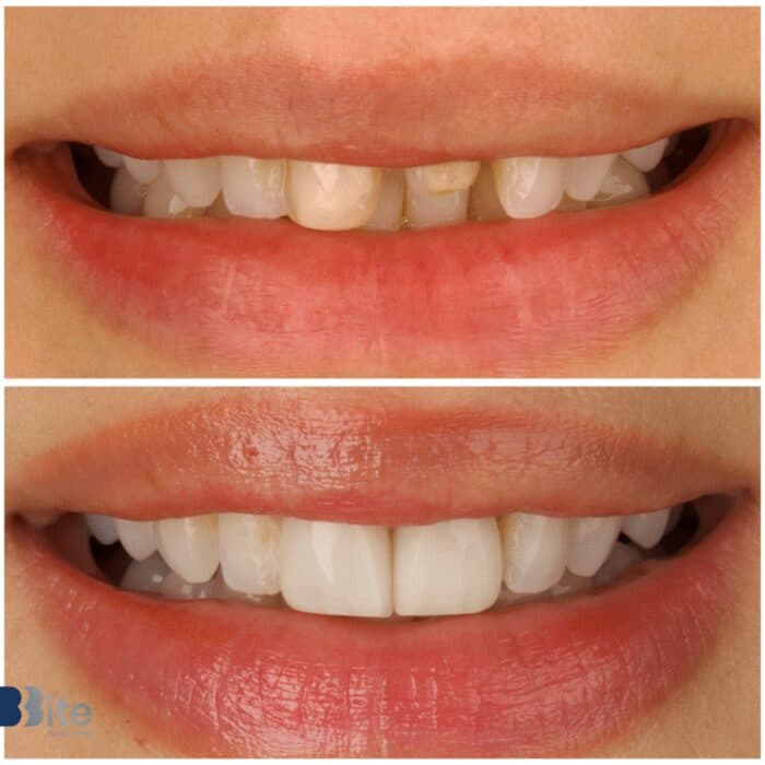 Porcelain veneers — before and after, Bite for Dentistry