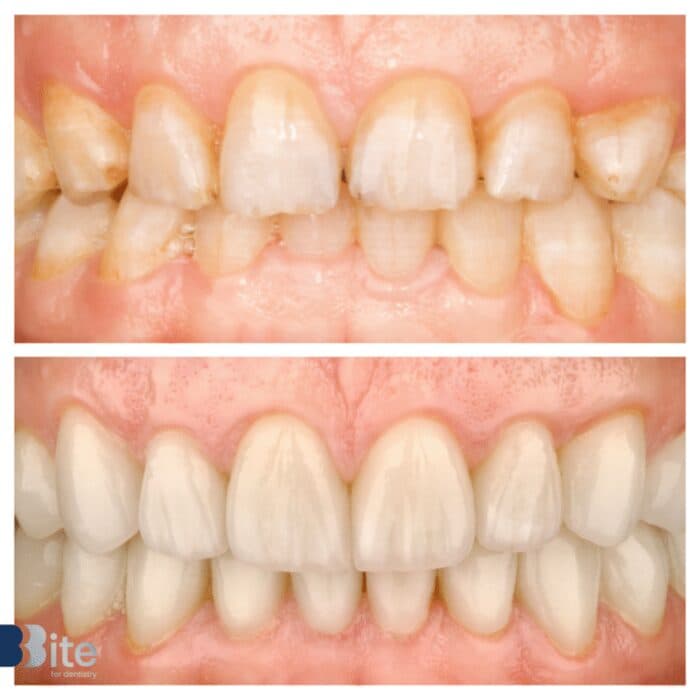 Porcelain veneers — before and after, Bite for Dentistry