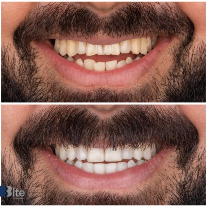 Teeth whitening — before and after, Bite for Dentistry