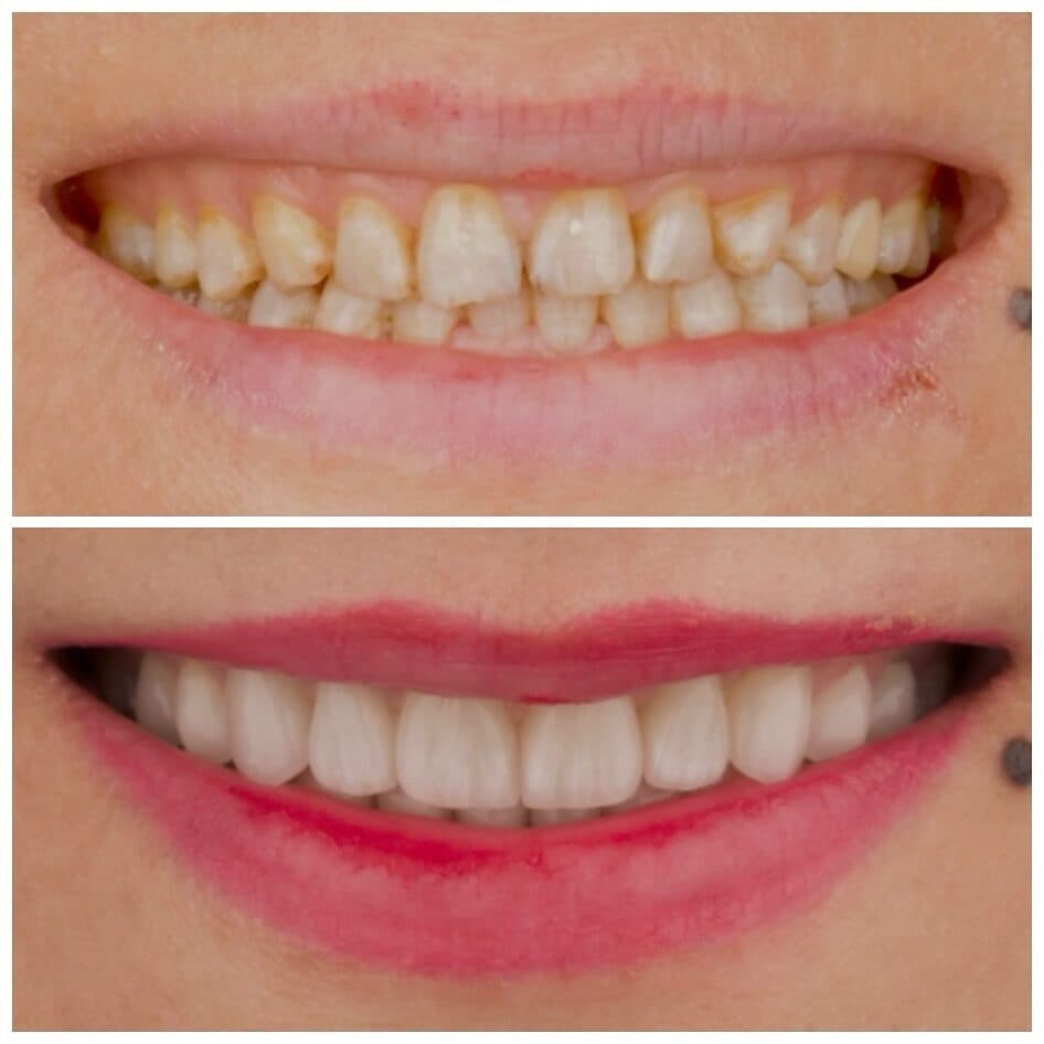 Porcelain veneers, before and after, by Dr. Zeen Dizaye (case 2)