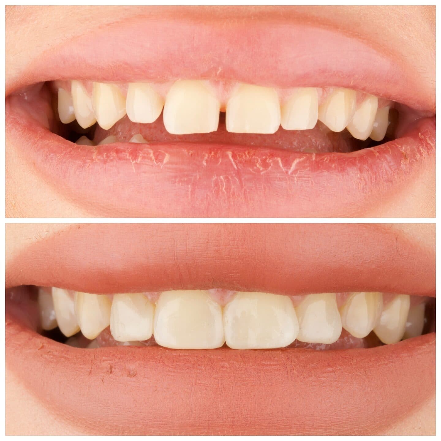 Composite bonding (gap closure), before and after, by Dr. Zeen Dizaye (case 4)
