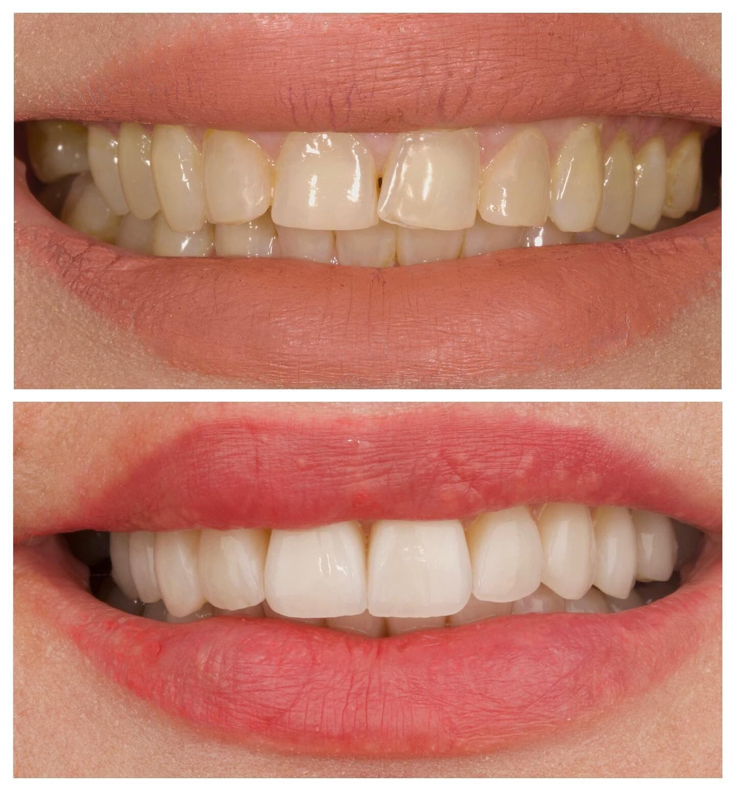Porcelain veneers, before and after, by Dr. Zeen Dizaye (case 8)