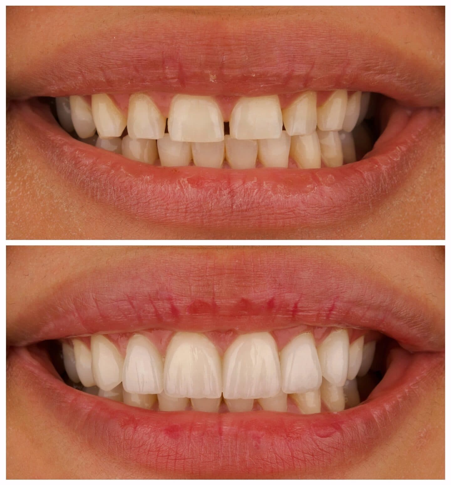 Porcelain veneers, before and after, by Dr. Zeen Dizaye (case 9)