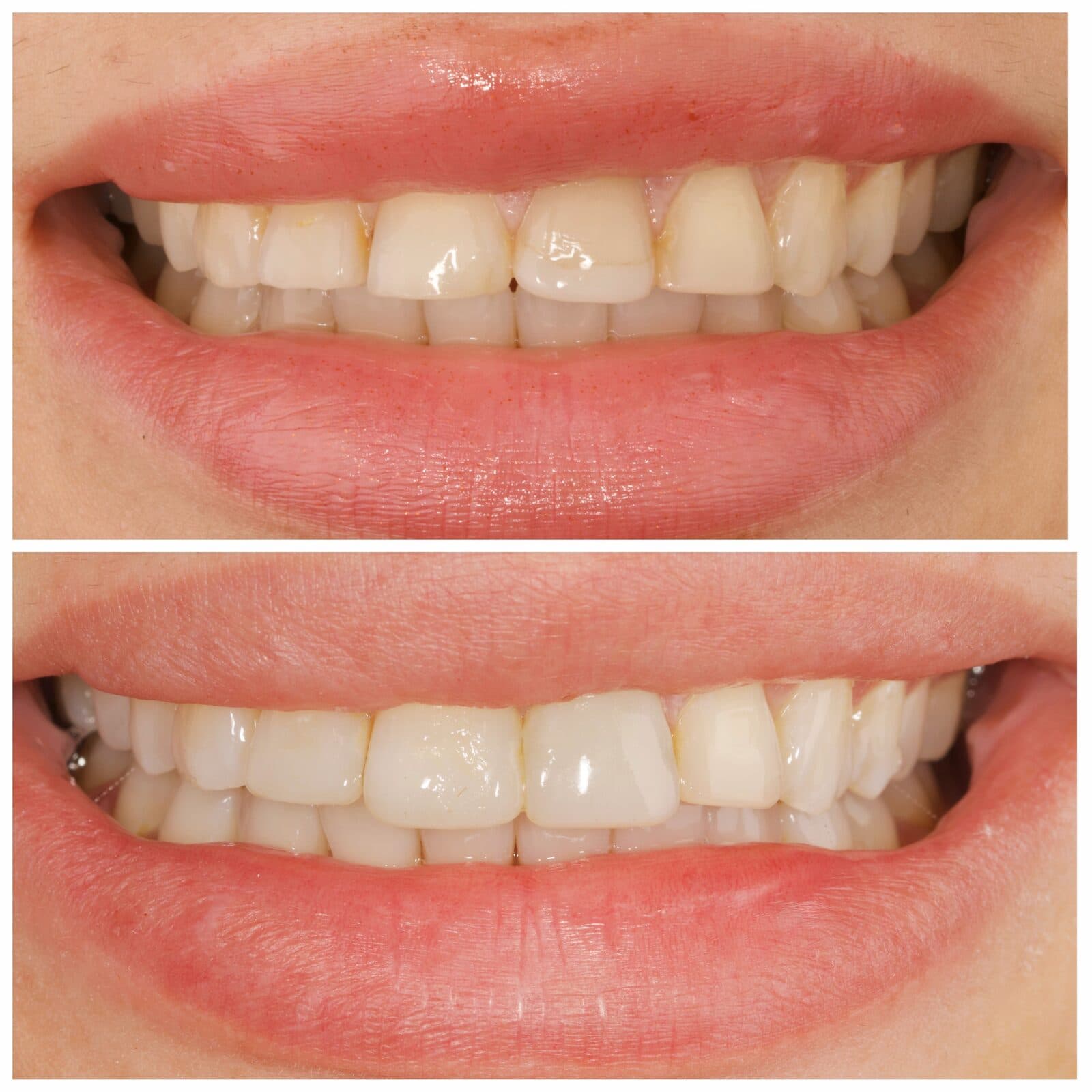 Composite bonding & whitening, before and after, by Dr. Zeen Dizaye (case 10)