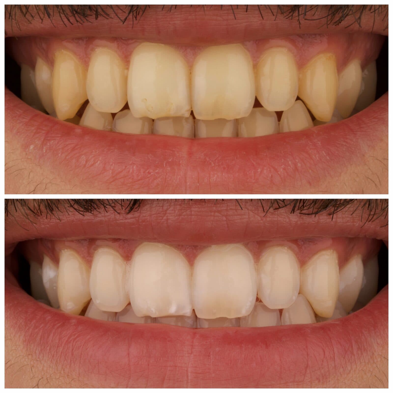 Teeth whitening, before and after, by Dr. Zeen Dizaye (case 11)